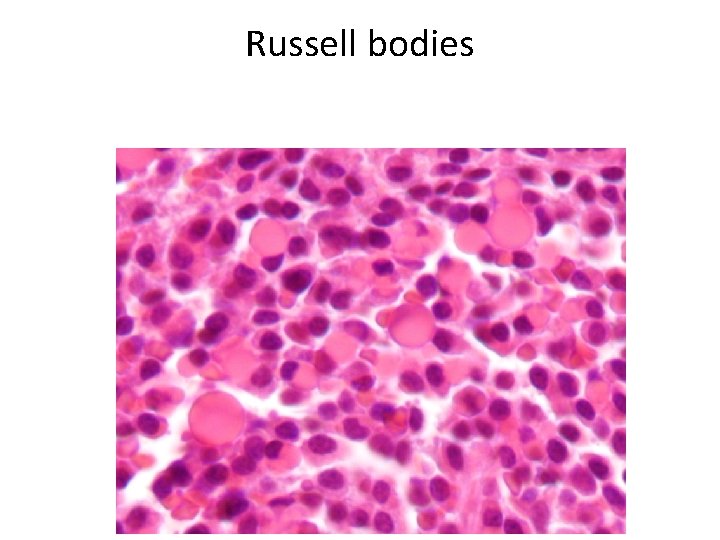 Russell bodies 