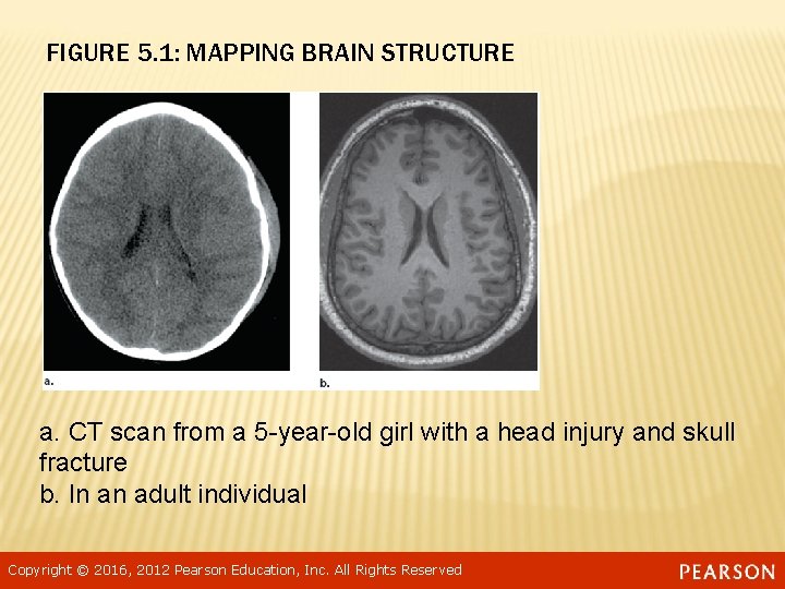 FIGURE 5. 1: MAPPING BRAIN STRUCTURE a. CT scan from a 5 -year-old girl