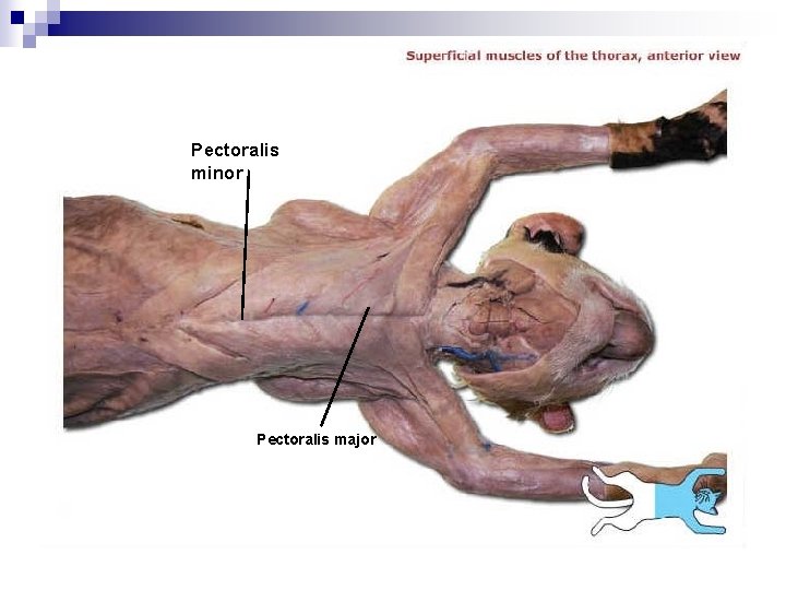 Pectoralis minor Pectoralis major 