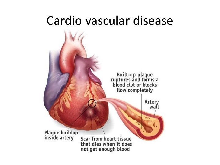 Cardio vascular disease 