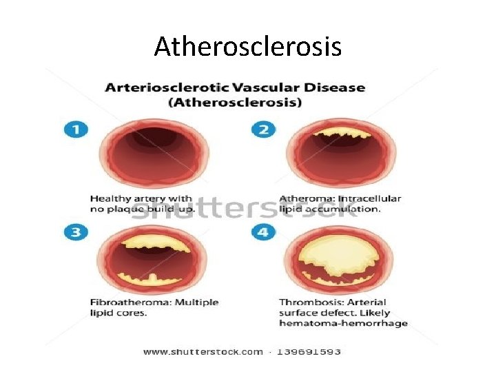 Atherosclerosis 