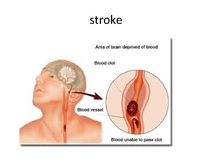 stroke 