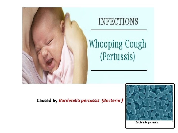 Caused by Bordetella pertussis (Bacteria ) 