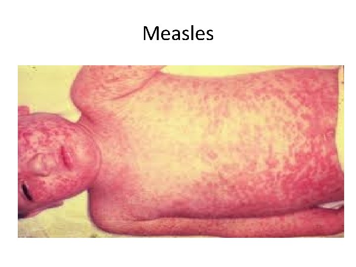 Measles 