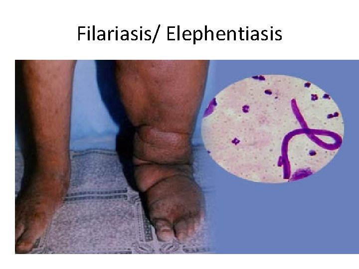 Filariasis/ Elephentiasis 