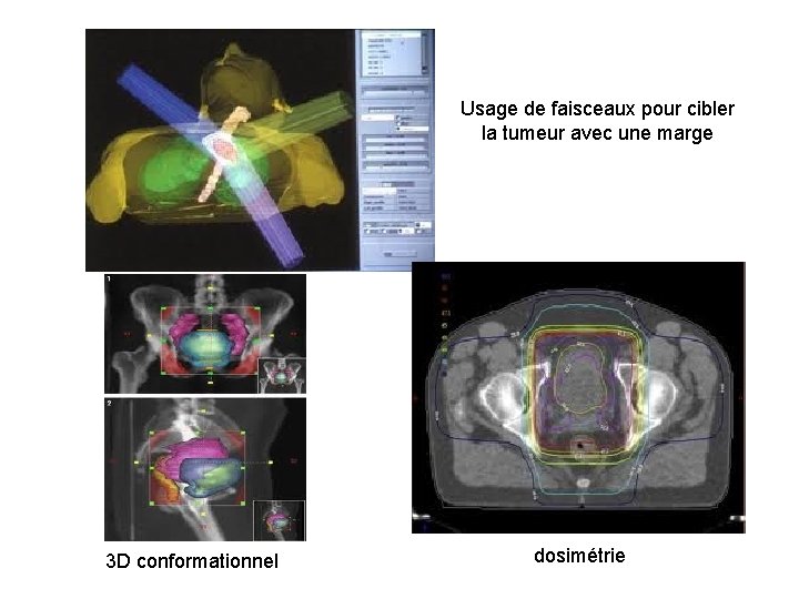 Usage de faisceaux pour cibler la tumeur avec une marge 3 D conformationnel dosimétrie