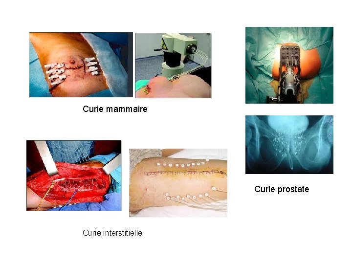 Curie mammaire Curie prostate Curie interstitielle 