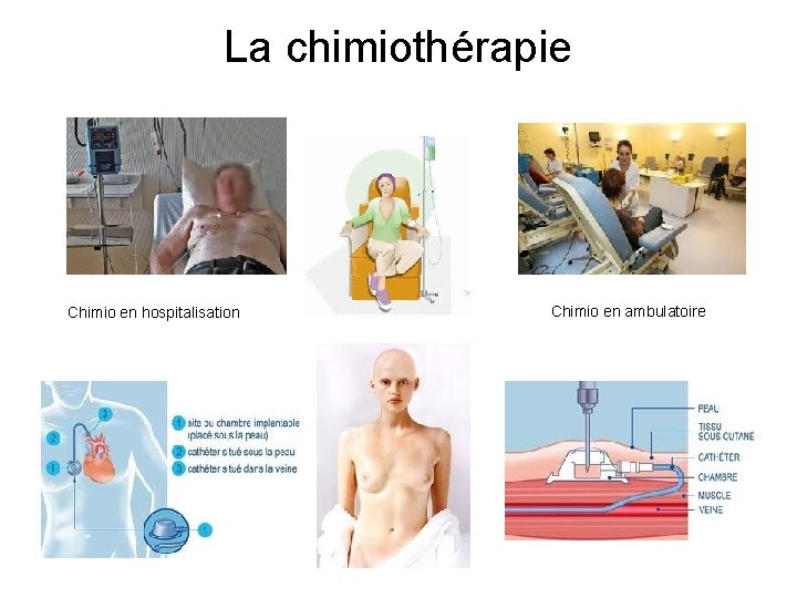 La chimiothérapie Chimio en hospitalisation Chimio en ambulatoire 
