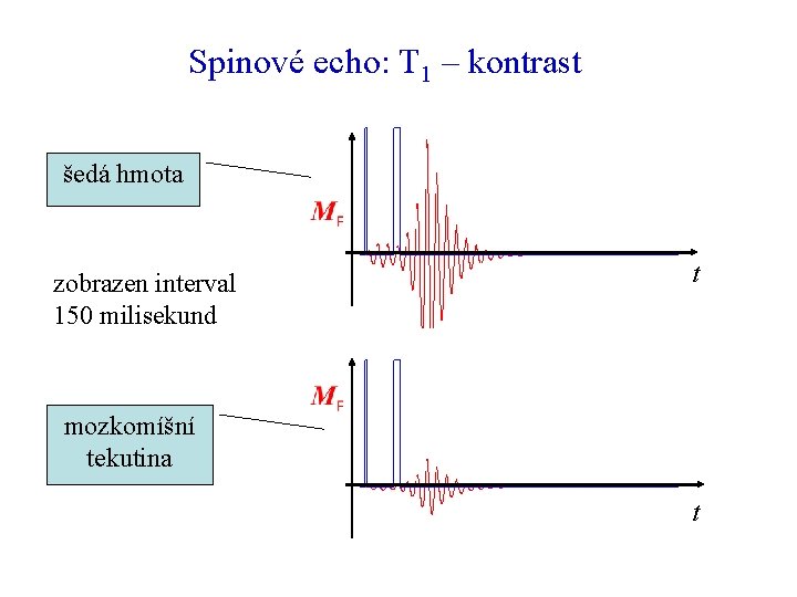 Spinové echo: T 1 – kontrast šedá hmota zobrazen interval 150 milisekund t mozkomíšní