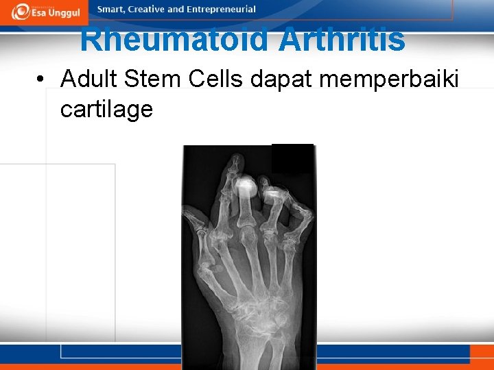 Rheumatoid Arthritis • Adult Stem Cells dapat memperbaiki cartilage 