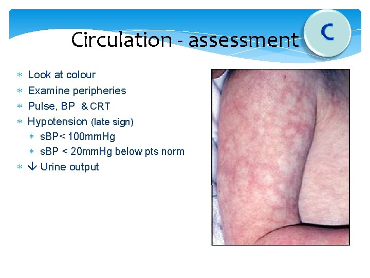 Circulation - assessment Look at colour Examine peripheries Pulse, BP & CRT Hypotension (late