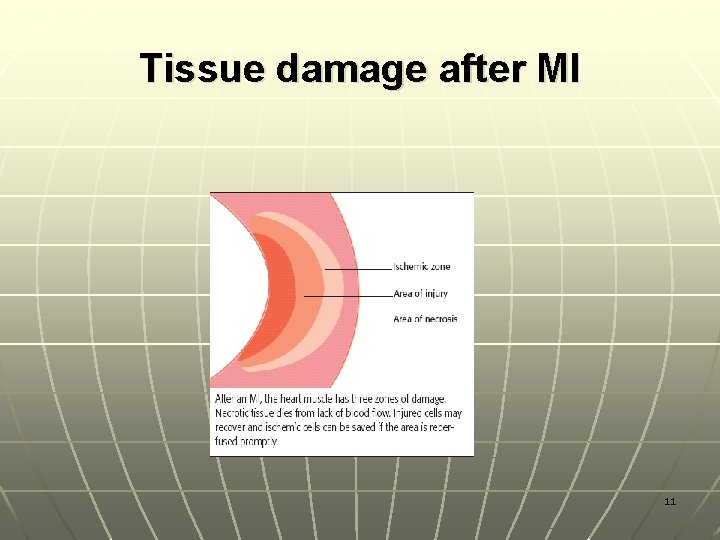 Tissue damage after MI 11 