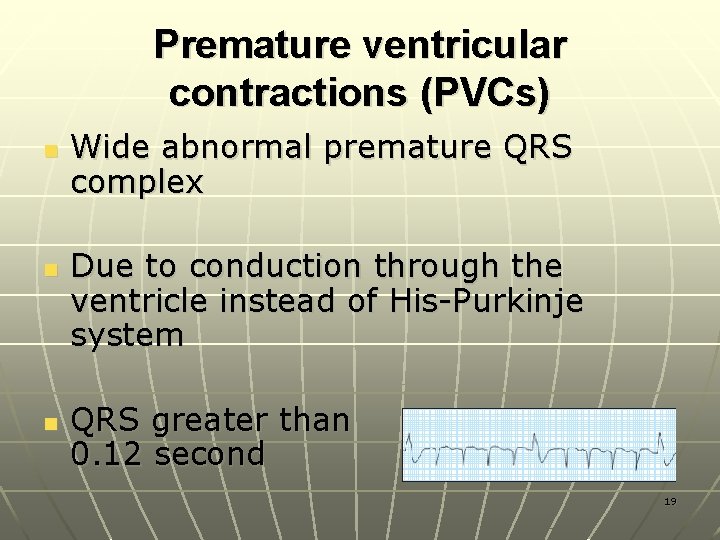 Premature ventricular contractions (PVCs) n n n Wide abnormal premature QRS complex Due to