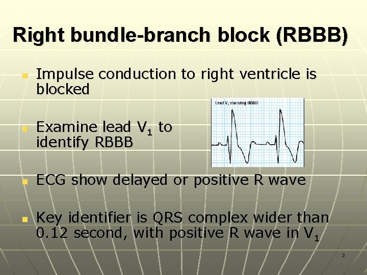 Right bundle-branch block (RBBB) n n Impulse conduction to right ventricle is blocked Examine