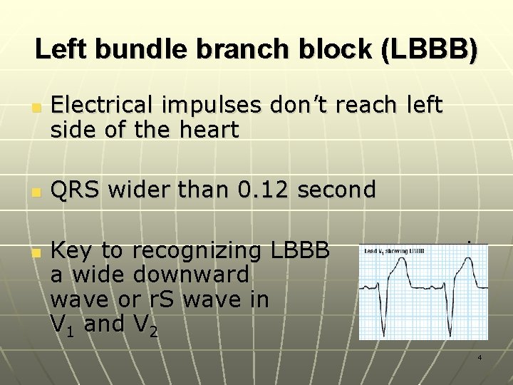 Left bundle branch block (LBBB) n n n Electrical impulses don’t reach left side