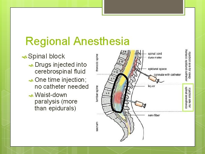 Regional Anesthesia Spinal block Drugs injected into cerebrospinal fluid One time injection; no catheter Regional Anesthesia Spinal block Drugs injected into cerebrospinal fluid One time injection; no catheter