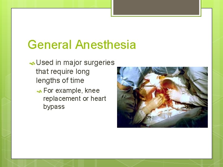 General Anesthesia Used in major surgeries that require long lengths of time For example, General Anesthesia Used in major surgeries that require long lengths of time For example,