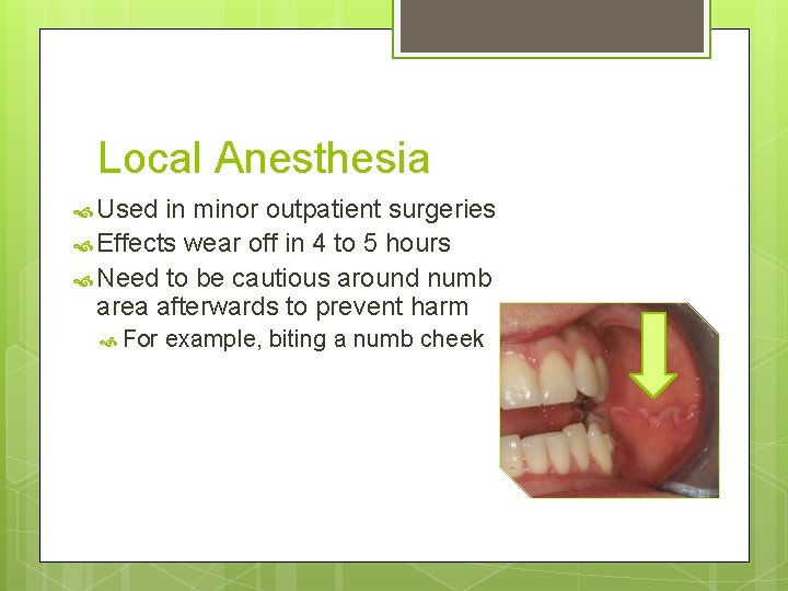Local Anesthesia Used in minor outpatient surgeries Effects wear off in 4 to 5 Local Anesthesia Used in minor outpatient surgeries Effects wear off in 4 to 5