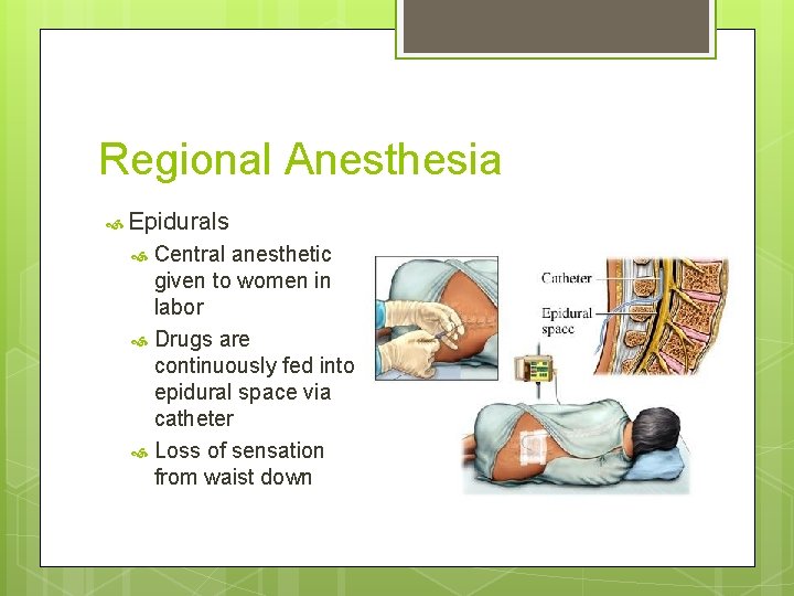 Regional Anesthesia Epidurals Central anesthetic given to women in labor Drugs are continuously fed Regional Anesthesia Epidurals Central anesthetic given to women in labor Drugs are continuously fed