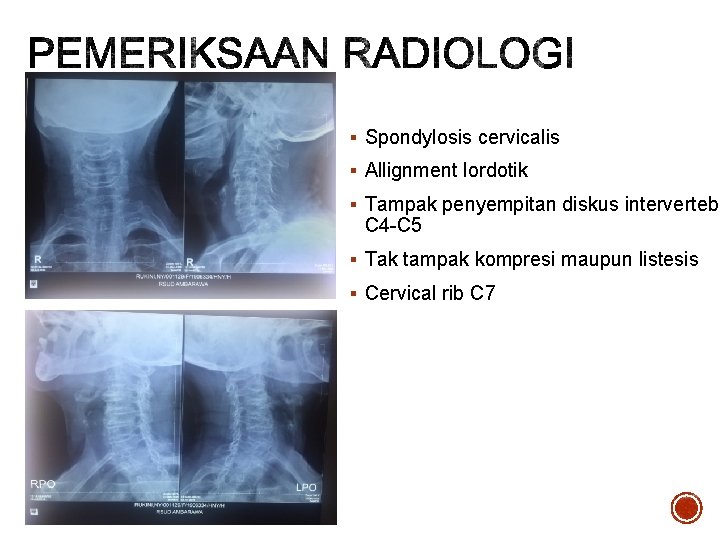 § Spondylosis cervicalis § Allignment lordotik § Tampak penyempitan diskus intervertebr C 4 -C