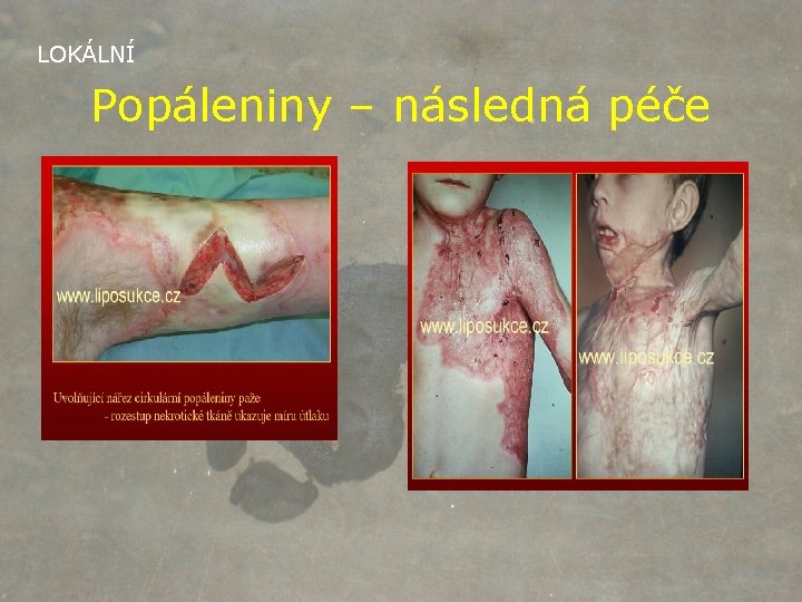 LOKÁLNÍ Popáleniny – následná péče 