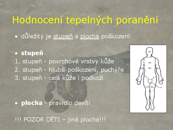 Hodnocení tepelných poranění • důležitý je stupeň a plocha poškození • stupeň 1. stupeň