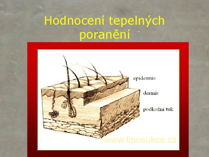 Hodnocení tepelných poranění 