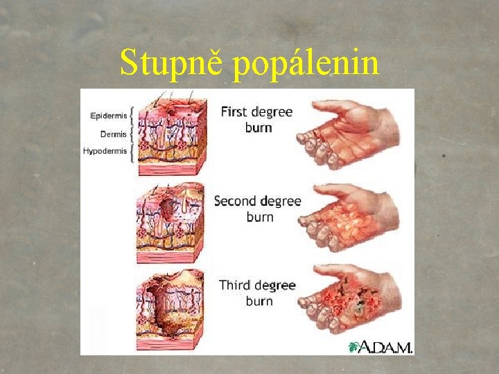 Stupně popálenin 