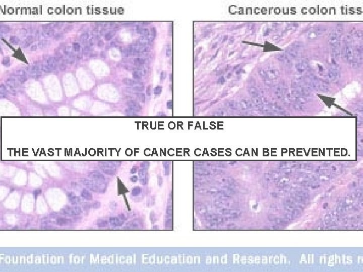 TRUE OR FALSE THE VAST MAJORITY OF CANCER CASES CAN BE PREVENTED. 