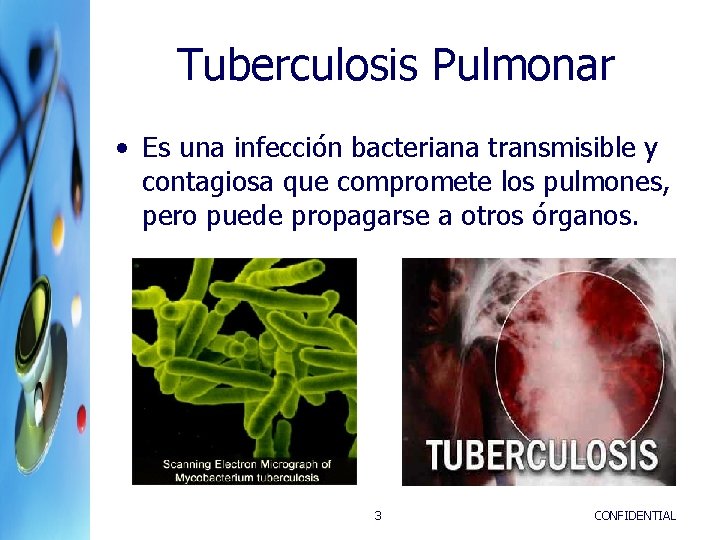 Tuberculosis Pulmonar • Es una infección bacteriana transmisible y contagiosa que compromete los pulmones,