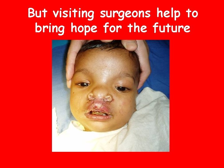 But visiting surgeons help to bring hope for the future 