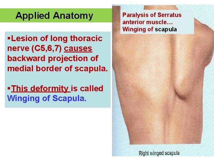 Applied Anatomy §Lesion of long thoracic nerve (C 5, 6, 7) causes backward projection