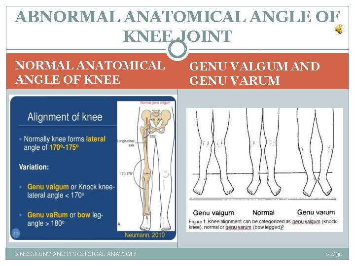 ABNORMAL ANATOMICAL ANGLE OF KNEE JOINT AND ITS CLINICAL ANATOMY GENU VALGUM AND GENU