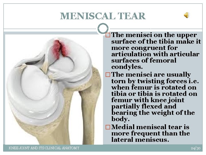 MENISCAL TEAR � The menisci on the upper surface of the tibia make it