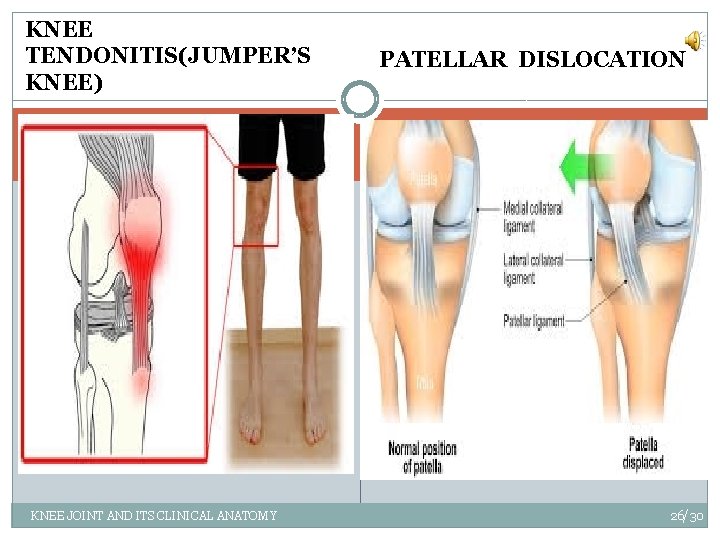 KNEE TENDONITIS(JUMPER’S KNEE) KNEE JOINT AND ITS CLINICAL ANATOMY PATELLAR DISLOCATION 26/30 