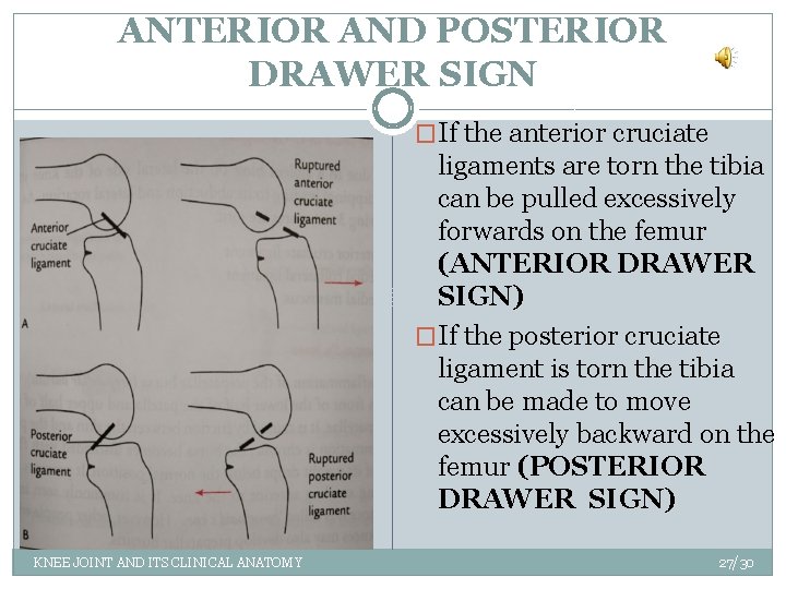 ANTERIOR AND POSTERIOR DRAWER SIGN �If the anterior cruciate ligaments are torn the tibia