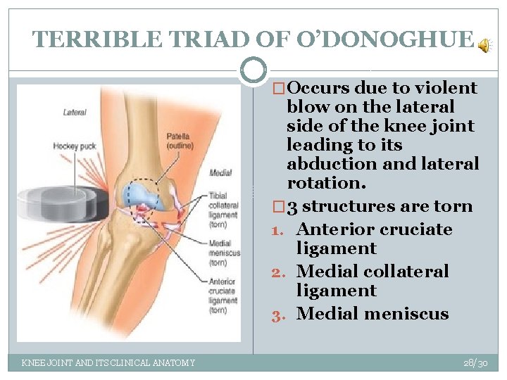 TERRIBLE TRIAD OF O’DONOGHUE �Occurs due to violent blow on the lateral side of