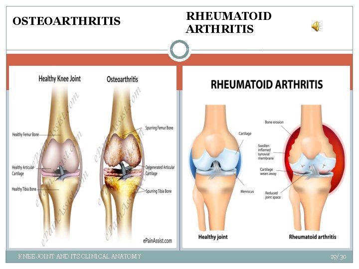 OSTEOARTHRITIS KNEE JOINT AND ITS CLINICAL ANATOMY RHEUMATOID ARTHRITIS 29/30 