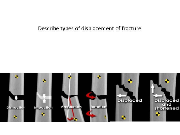 Describe types of displacement of fracture 