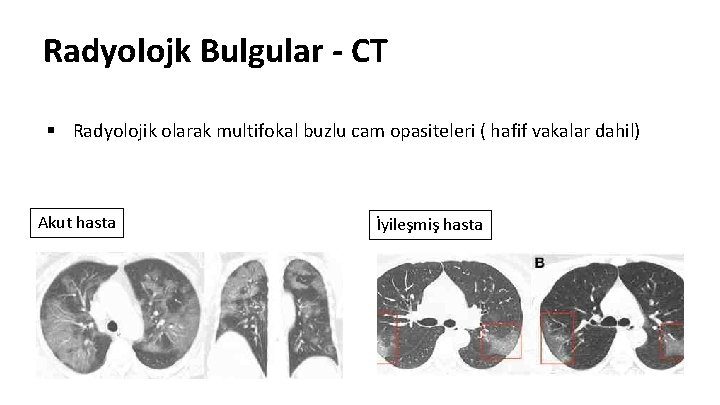 Radyolojk Bulgular - CT § Radyolojik olarak multifokal buzlu cam opasiteleri ( hafif vakalar