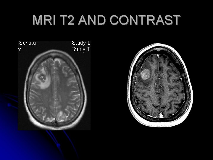 MRI T 2 AND CONTRAST 