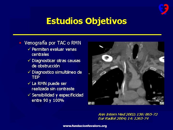 Estudios Objetivos § Venografía por TAC o RMN ü Permiten evaluar venas centrales ü