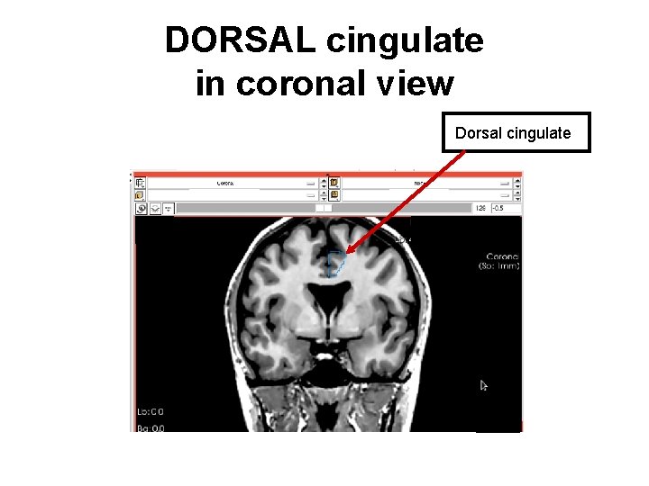 DORSAL cingulate in coronal view Dorsal cingulate 