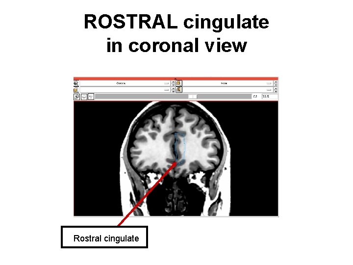 ROSTRAL cingulate in coronal view Rostral cingulate 