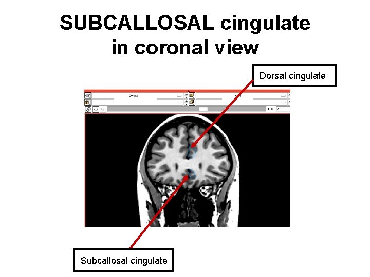SUBCALLOSAL cingulate in coronal view Dorsal cingulate Subcallosal cingulate 