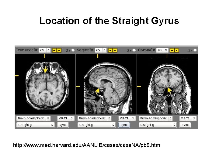 Location of the Straight Gyrus http: //www. med. harvard. edu/AANLIB/cases/case. NA/pb 9. htm 