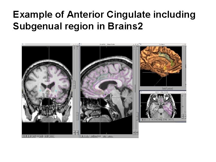 Example of Anterior Cingulate including Subgenual region in Brains 2 