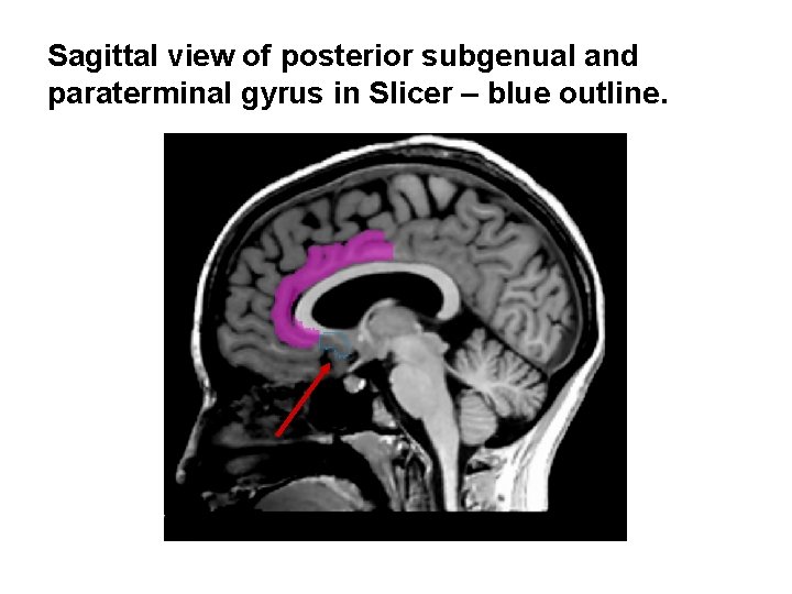 Sagittal view of posterior subgenual and paraterminal gyrus in Slicer – blue outline. 