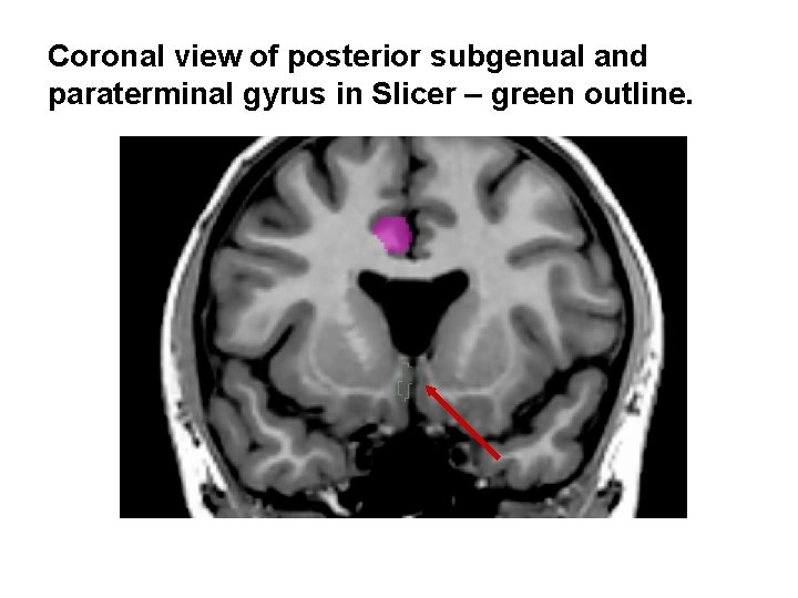 Coronal view of posterior subgenual and paraterminal gyrus in Slicer – green outline. 