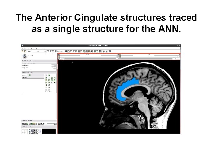 The Anterior Cingulate structures traced as a single structure for the ANN. 